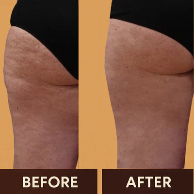 Serouna® Anti-Cellulite Massage Oil