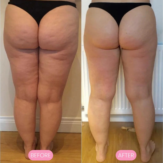 Serouna™ Cellulite Massager