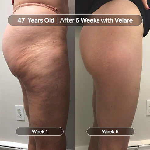 Serouna® Anti-Cellulite Massage Oil